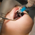 Is IV Sedation Safe for Dental Work?
