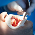 Say Goodbye To Dental Anxiety: How Sedation Dentistry Makes Dental Implants In Waco A Breeze