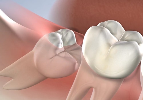 Can I Have My Wisdom Teeth Removed While Under the Effects of Sedation Dentistry?